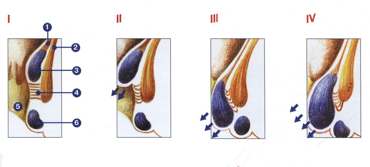 hemorojaus vystymosi etapai