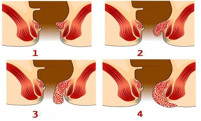 kaip atrodo hemorojus įvairiais etapais